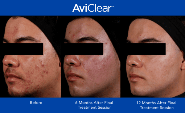 AviClear Before and After Template_12 month_2