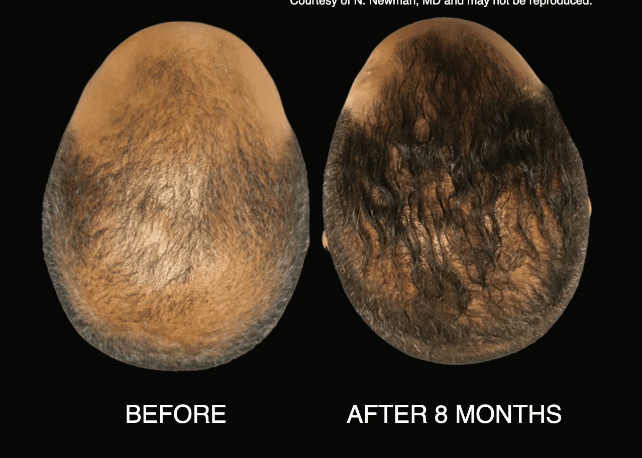 hair restoration