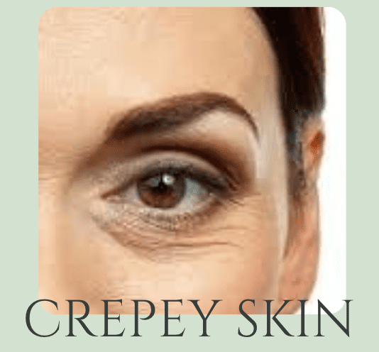 crepey under eye skin