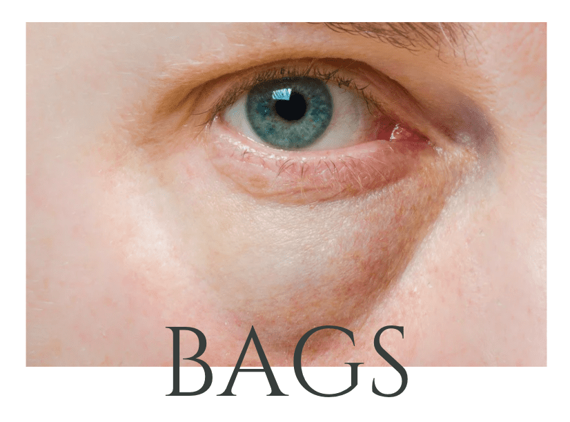 under eye bags