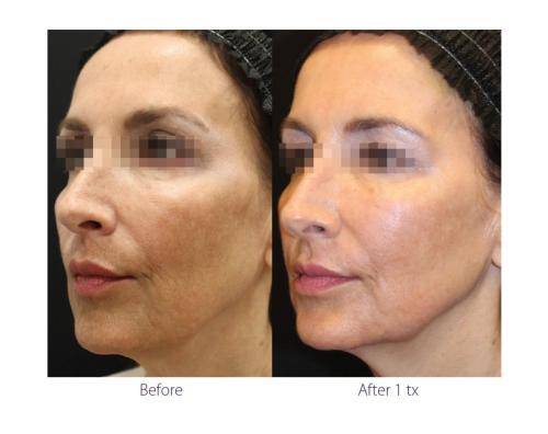 clearlift before and after